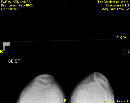 Obraz radiologiczny po uszkodzeniu więzadeł stabilizujących rzepkę