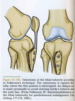 Schemat osteotomii wg Fulkersona